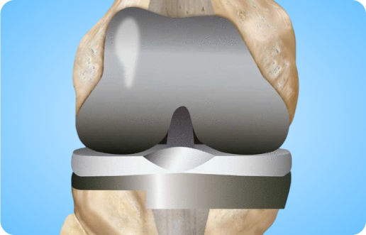 Revision Knee Replacement