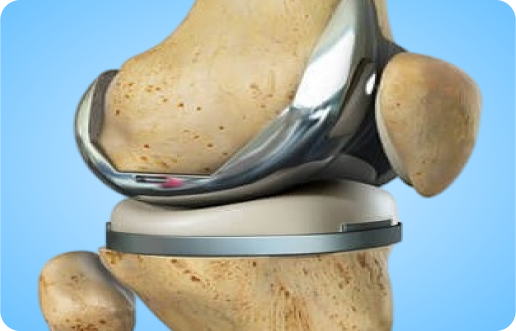 Total Knee Replacement