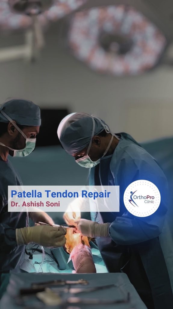 Orthopedic Insight: Understanding Patella Tendon Tears