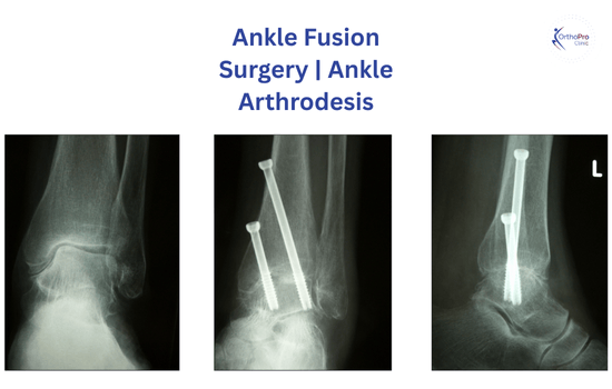 Ankle Fusion Surgery In Dubai 1 Ankle Fusion Surgery Ankle Arthrodesis (1)