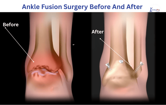 Ankle Fusion Surgery In Dubai 2 Ankle Fusion Surgery Before And After Before After