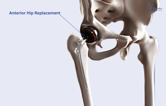 Anterior Hip Replacement (1)
