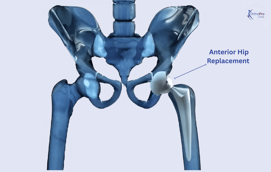 Anterior Hip Replacement (2)