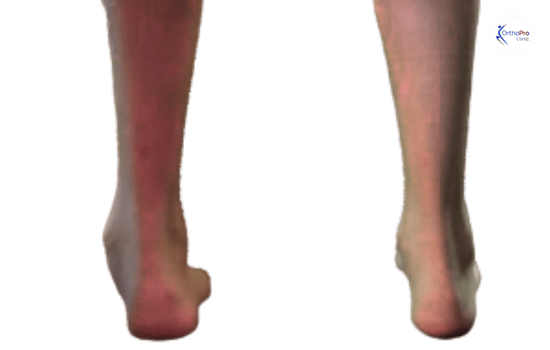 before and after image of Flatfoot Reconstruction surgery