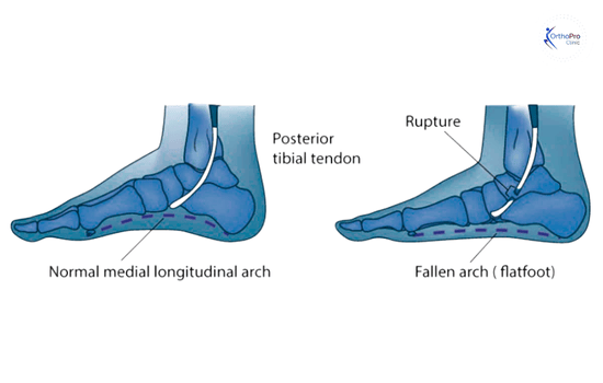 Flatfoot Reconstruction in Dubai