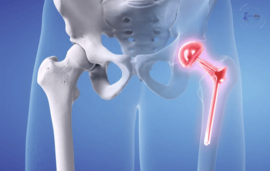 Hip Preservation Surgery In Dubai - 1