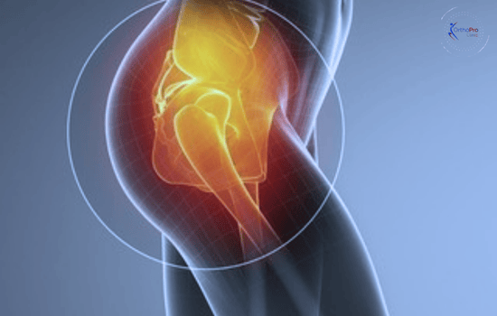 Hip Preservation Surgery In Dubai - 2