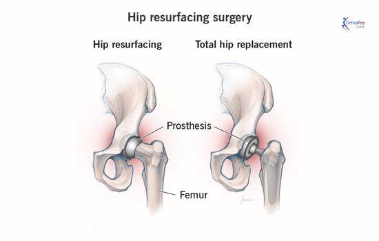 Hip Resurfacing Surgery In Dubai