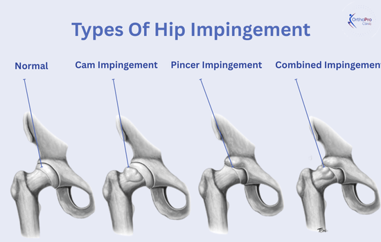 Hip Impingement Syndrome 234 Types Of Hip Impingement