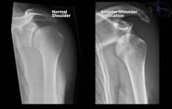 Anterior Shoulder Dislocation x ray