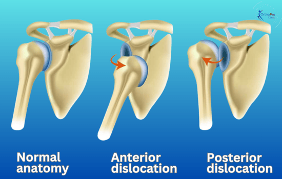 difference between Anterior and Posterior Shoulder Dislocation