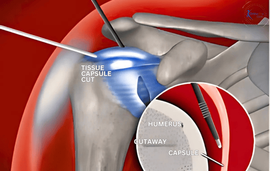 Arthroscopic Frozen Shoulder Release 2 Arthroscopic release for a frozen shoulder