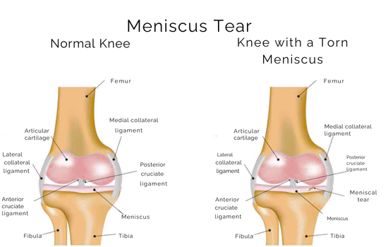 Meniscus Tear Normal vs Torn