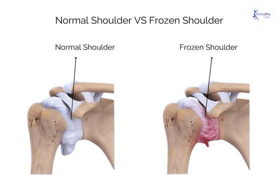 Normal Shoulder VS Frozen Shoulder