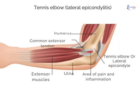 Tennis elbow (lateral epicondylitis)