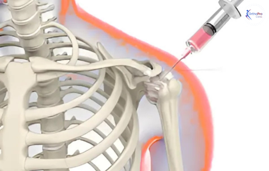 Arthroscopic Frozen Shoulder Release 1 injectables in frozen shoulder