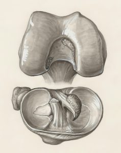 Chondromalacia Patella 6 4The Hidden Crack Why Your Persistent Joint Pain Might Be Osteochondritis Dissecans