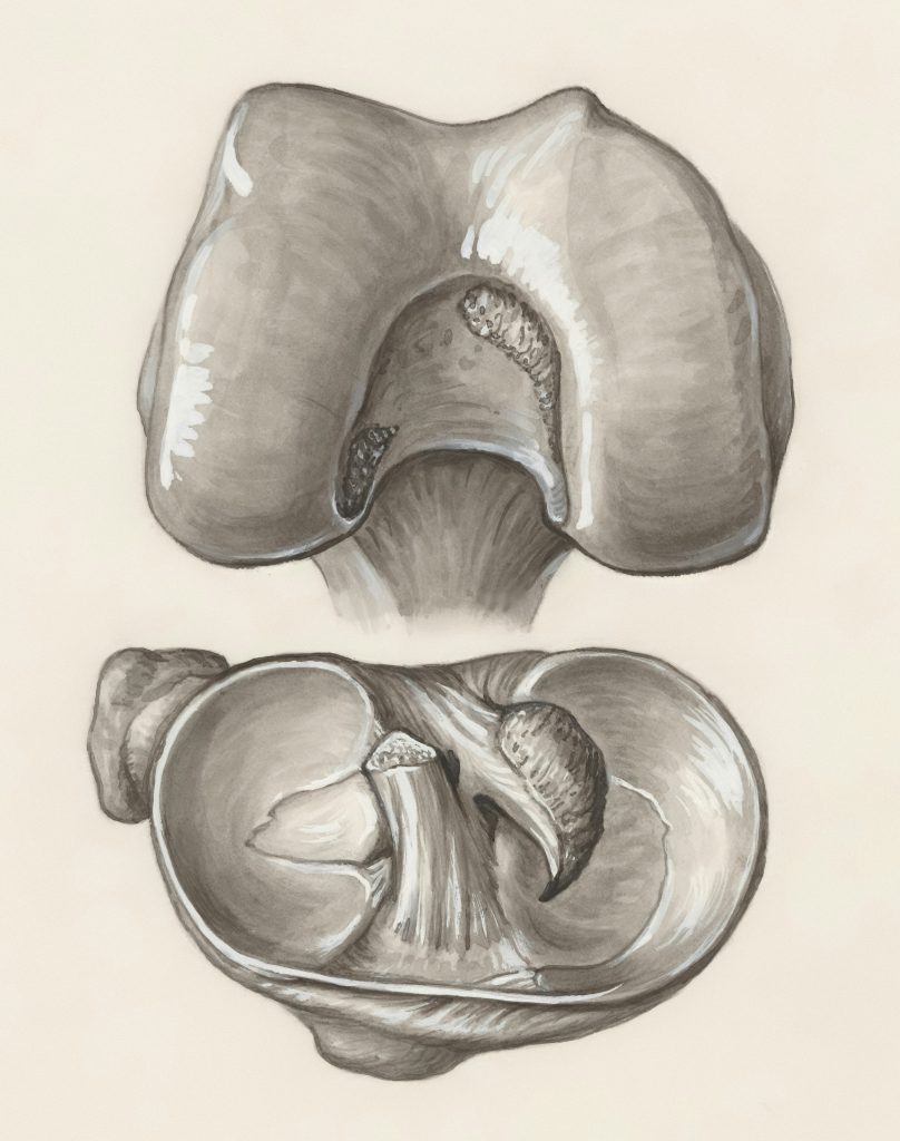 The Hidden Crack: Why Your Persistent Joint Pain Might Be Osteochondritis Dissecans 235 4The Hidden Crack Why Your Persistent Joint Pain Might Be Osteochondritis Dissecans