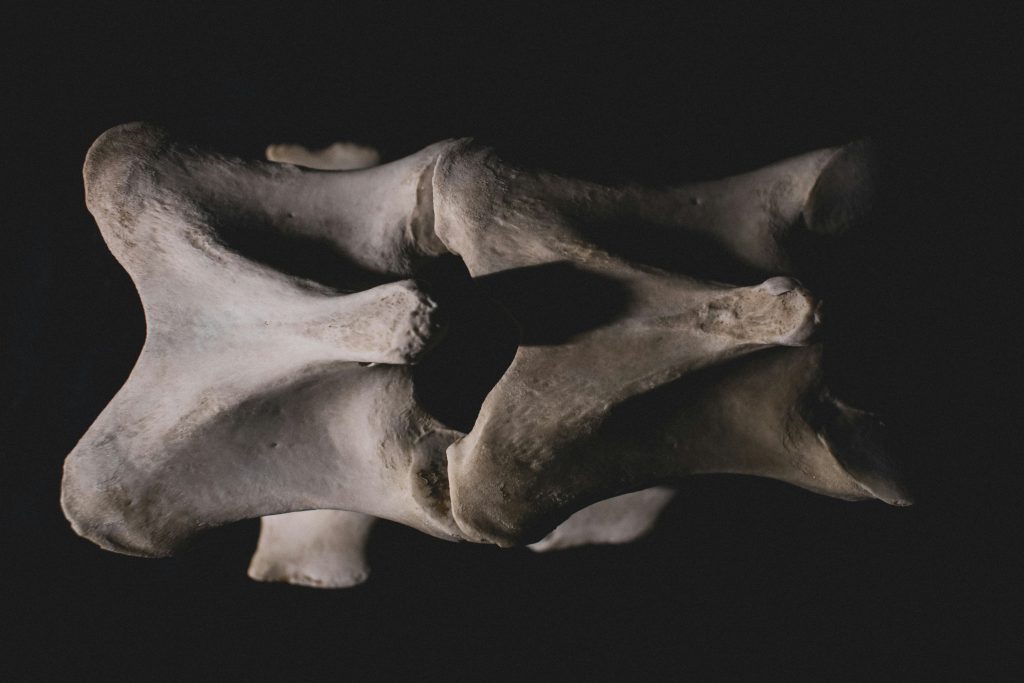 Tibia Bone Fracture 2 orthopro Tibia Bone Fracture