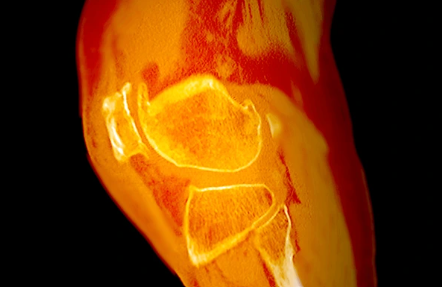 Fractures Of The Patella
