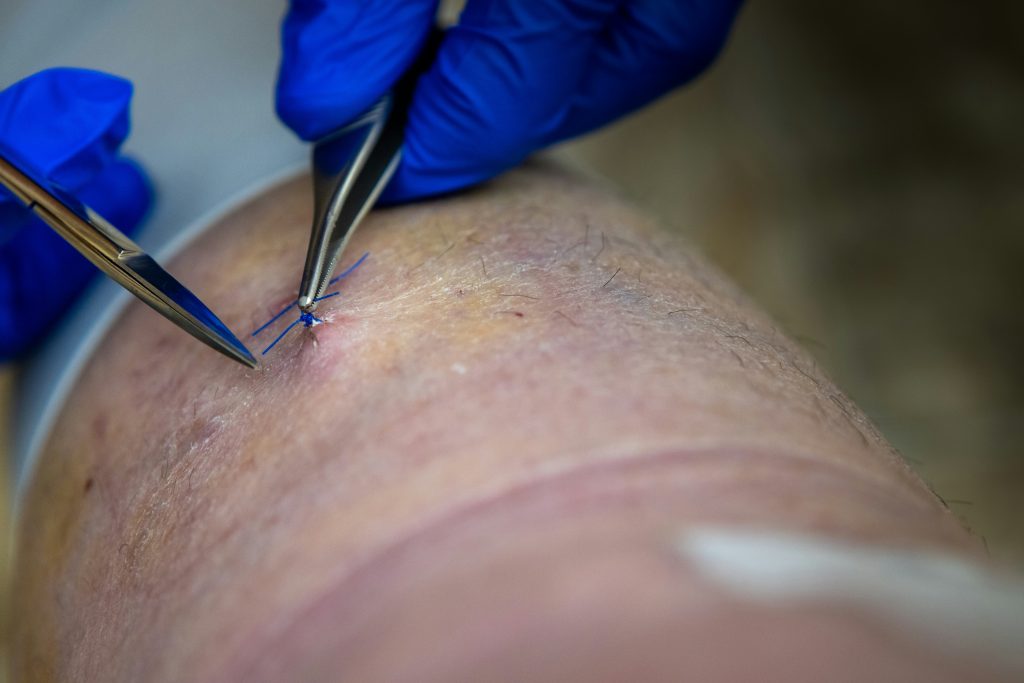Osteochondritis Dissecans
