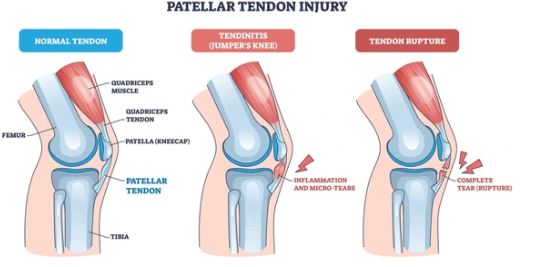 Patellar Tendon Rupture