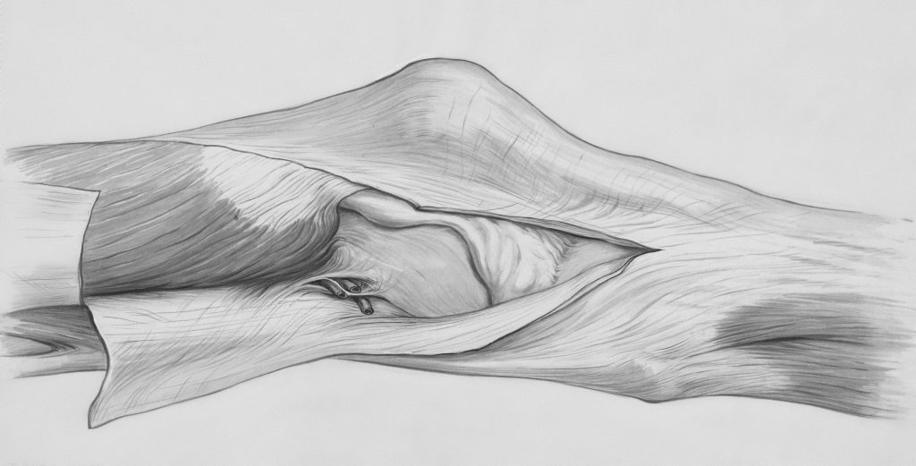 Quadriceps Tendon Rupture And Repair 2 Quadriceps Tendon