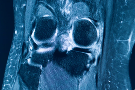 What is Multiligament Instability