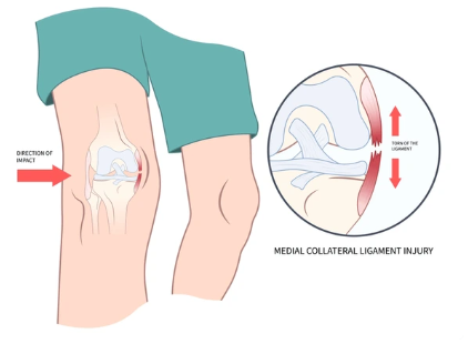 meniscal injuries