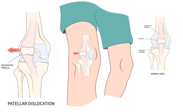 Meniscal Tears 6 meniscus