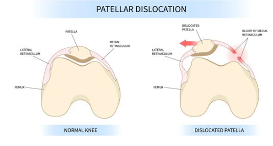 patellar dislocation