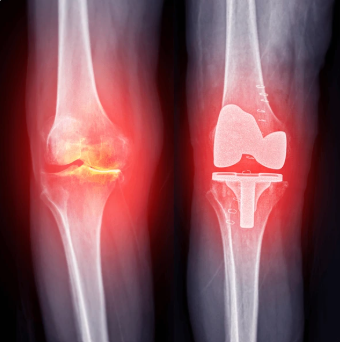 patellar fracture